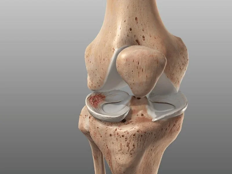 Lesões Ligamentares e Meniscais